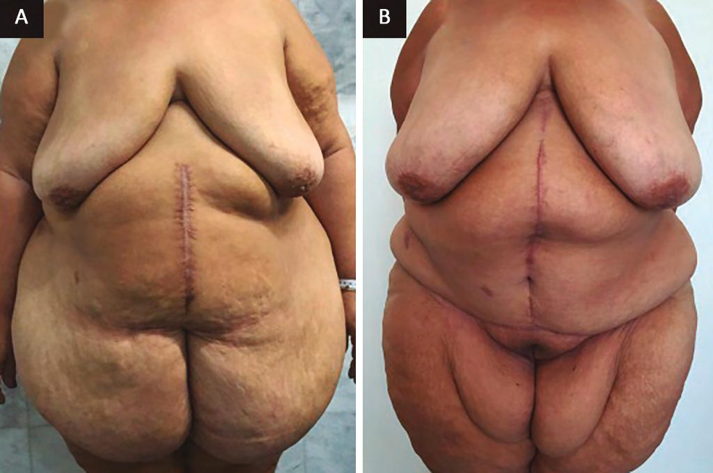 O IMC dos pacientes antes da abdominoplastia variou de 21,9 a 36,7 kg/m 2 e média de 27,9 kg/m 2. A perda ponderal variou de 29 kg a 85 kg, com média de 48,14 kg.