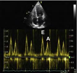 Avaliação da função diastólica A
