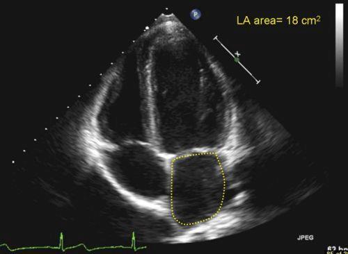 E septal <7cm/s ou e lateral < 10cm/s