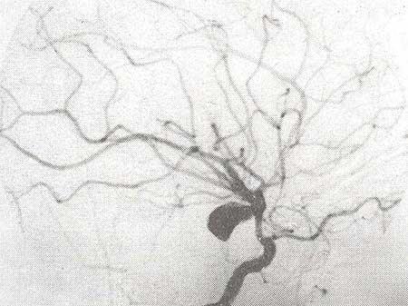 As imagens abaixo mostram dois aneurismas respectivamente da artéria comunicante posterior (mais comum) e da artéria