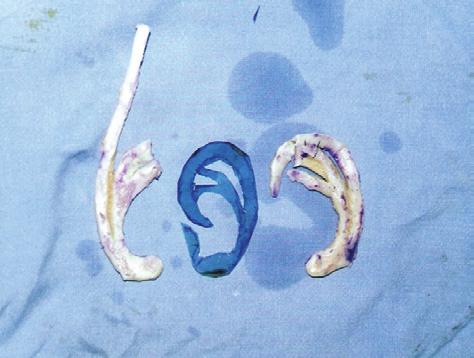 Figura 7 Cartilagem costal bipartida e moldada