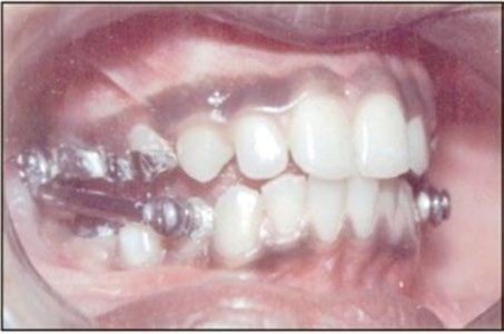 Fig. 1. Aparelho Herbst. Adaptado de International Journal of Contemporary Dentistry, 2011 2. 15 Fig. 2. Twin Block (Imagem cedida por Prof. Doutor Paulo Retto).