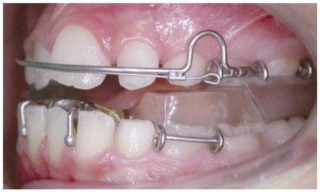 Fig. 3. Twin Block (vista lateral) (Imagem cedida por Prof. Doutor Paulo Retto). Fig. 4. Forsus (vista lateral) (Imagem cedida por Prof.