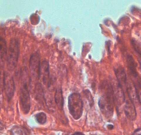 FIGURA 03 Identificação da apoptose nos cortes corados em Hematoxilina- eosina Figura 01 Figura 03 - Micrografia de endométrio mostrando a presença de células em apoptose.