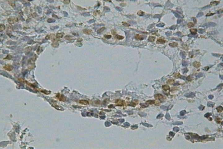 . Figura 04 Fotomicrografia :observar a marcação positiva para a fragmentação do genoma (TUNEL +) nas células epiteliais glandulares indicadas com a seta (TUNEL, contracoloração hematoxilina objetiva