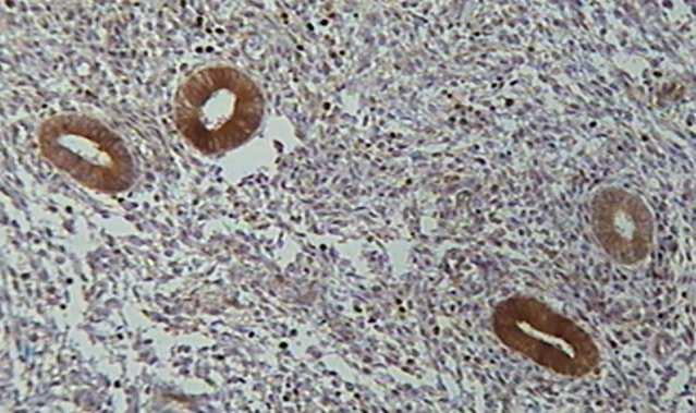 Figura 05 - Fotomicrografia com aumento de 40x no implante de endometriose mostrando reação fortemente positiva do Bcl-2 nas glândulas endometriais contracoradas com Hematoxilina.