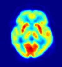 Lua Positron emission tomography (PET)