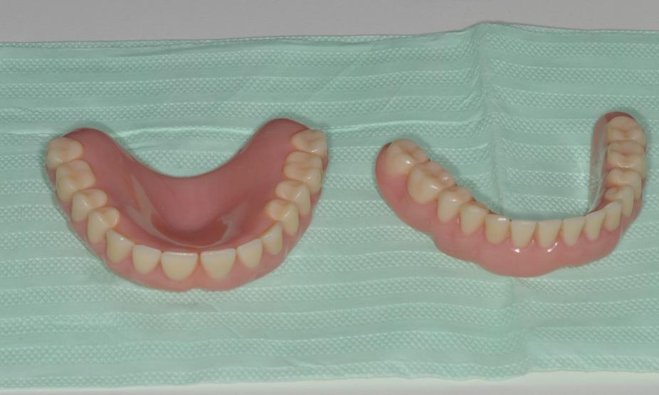 1). Paciente relatou que a overdenture estava com os dentes com facetas de desgastes e apresentava retenção deficiente.