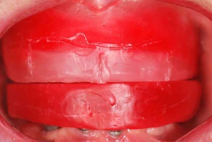 Adaptação dos análogos na moldagem de transferência Na sessão seguinte, foi realizada a moldagem funcional da maxila com pasta zinco enólica após selamento periférico com godiva em bastão.