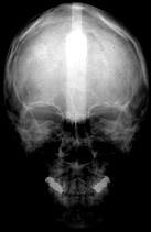 Nestes casos, partes do esqueleto do corpo humano podem ser utilizadas para identificação, tais como registros dentários, tórax, vértebras, ombros e o sinus frontal.