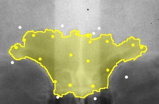 A Figura 4(b) exibe a segmentação manual do sinus frontal obtida, sob supervisão de um radiologista, a partir da imagem da radiografia apresentada na Figura 4(a).