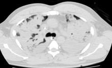 Figure 1: Thoracic tomographic assessment of maximal recruitment strategy in an ARDS patient (before and after recruitment maneuver and tomographic PEEP titration).