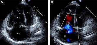 Pulmonary Hypertension, right ventricular dysfunction and ARDS TPG >12 mm Hg X TPG < 12 mmhg ARDS mortality Sub-group stratification ( 15-20%): (30% vs. 19%; P=0.02) 1. High mortality 2.