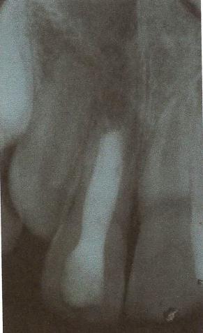 19 Figura 8 Radiografia periapical do elemento 11