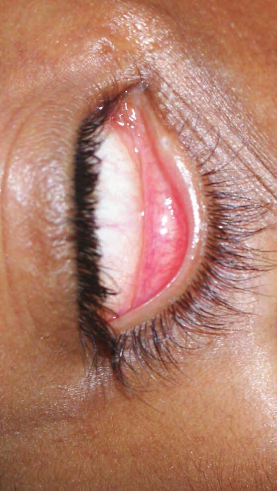 Secretaria de Vigilância em Saúde Figura 4 Outras manifestações Outros sinais e sintomas descritos na fase aguda de chikungunya são dor retro-ocular, calafrios, conjuntivite (Figura 4 hiperemia da