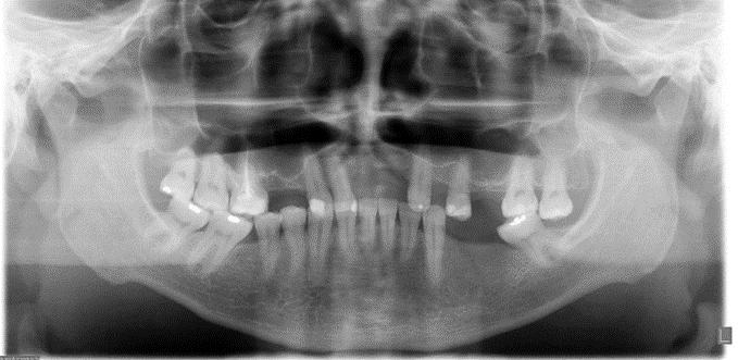 1. INTRODUÇÃO O seio maxilar é uma cavidade que apresenta-se com formato piramidal situado em região de maxila, estendendo-se anteriormente até região de canino e/ou pré molar, posteriormente, pode