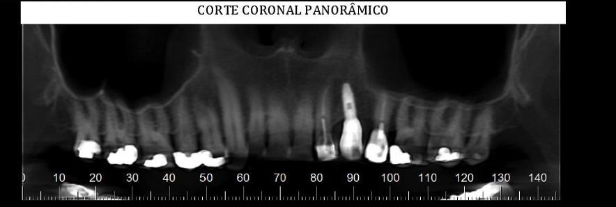 Após 3 meses, o paciente foi chamado para a primeira revisão na qual foi solicitado nova tomografia a fim de