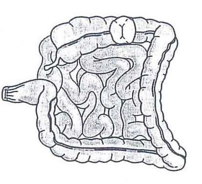 Figura 1- Tipos de Colostomia Colostomia do ascendente Transversostomia Colostomia do