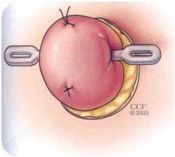 Figura 2 - Ostomia de Eliminação em Ansa Fonte: Fazio, Church & Wu (2012) Atlas of Intestinal Stomas.