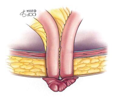 O restante intestino distal poderá ser removido cirurgicamente, suturado por cima de modo a formar a