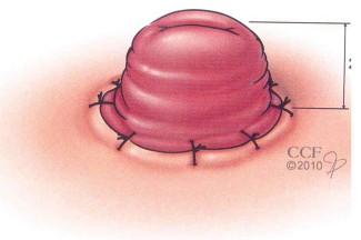 mucosa (segrega muco e necessita de penso) (Fazio, Crurch & Wu, 2012).