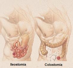 Guia do cliente ostomizado 2-O QUE É UMA OSTOMIA DE ELIMINAÇÃO INTESTINAL A palavra ostomia é de origem grega e tem como significado abertura ou boca.