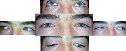 Orbitopatia Tiroideia: Diferentes Formas de Apresentação, Diferentes Abordagens Terapêuticas oftalmológico destacava-se discreto edema e hiperémia palpebral bilateral, mais evidente à direita.