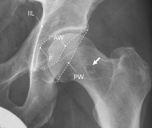 [2] Figura 7 Figura 7: Radiografia antero-posterior da bacia, observando-se características CFA em ambas as ancas.