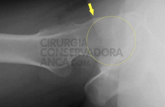 A patologia tipo CAM é a causa do impacto femoro-acetabular, onde a porção não esférica da cabeça do fémur entra em conflito com a articulação.