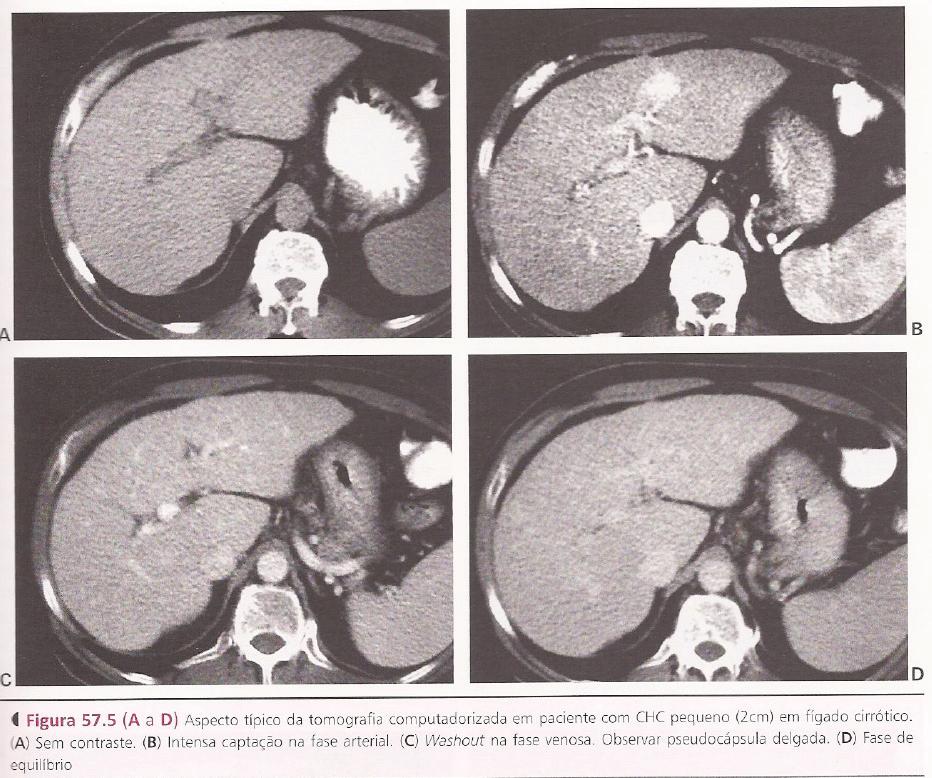 fenômeno é conhecido como washout (lavagem rápida). A presença de absorção arterial seguida de washout é altamente específica de CHC (1,2,8). (8) 8.