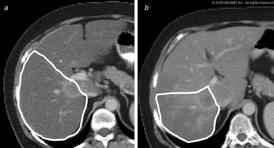 SELEÇÃO DOS PACIENTES PARA RESSECÇÃO HEPÁTICA VOLUMETRIA HEPÁTICA