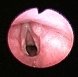 hiperemia e edema subglótico (Grupo II) FNL após extubação: edema e granulação subglótica, tecido