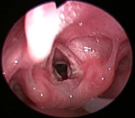 114 FNL após extubação: granulação subglótica, ulceração e hiperemia em processo vocal da