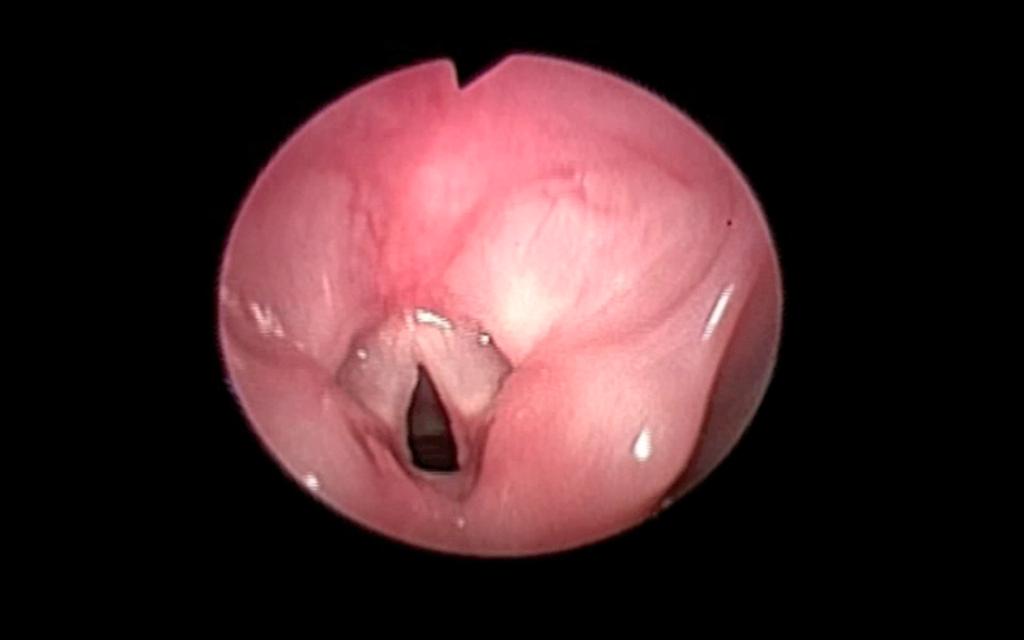 ulceração e hiperemia em terço posterior da prega vocal esquerda e processo vocal da aritenóide