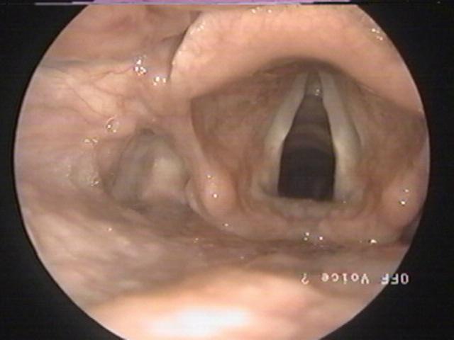 25 Região subglótica (anel cricóide anterior) Superfície medial da aritenóide Glote posterior Figura 2. Anatomia da laringe.