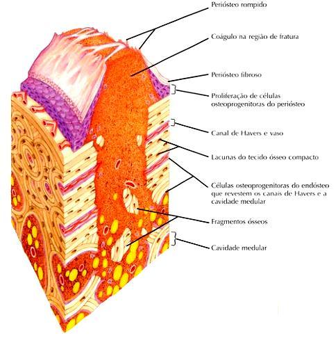 periósteo Proliferação de células progenitoras do periósteo (calo externo) e do endósteo (calo interno)