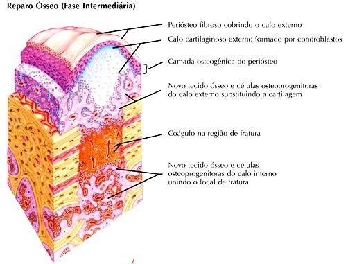 Reparo da Fratura Óssea Periósteo fibroso cobrindo o calo externo Calo cartilaginoso externo formado por condroblastos Camada