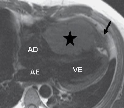 contraste endovenoso Tumor cardíaco metastático em ventrículo direito ( ) AD