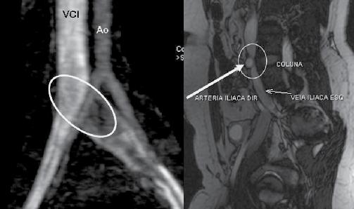 Síndrome de Cockett Angio-ressonância magnética VCI =
