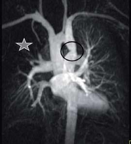 Angio-RM = Coarctação de aorta = Déficit de