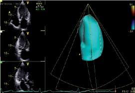 INTRODUÇÃO Apesar da ecocardiografia ter o poder de avaliar a funcionalidade do coração como um todo, são as avaliações da função ventricular, qualitativa e quantitativa, as mais importantes