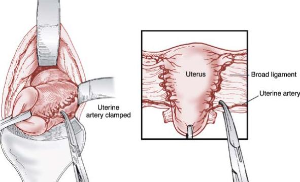 TÉCNICA CIRÚRGICA Corte e laqueação das artérias uterinas Posicionamento do clampe paralelamente ao eixo do útero, incorporando os