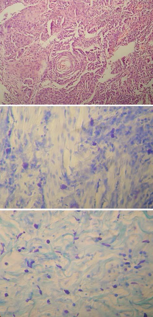 Comparação entre a concentração de mastócitos em carcinomas espinocelulares da pele e da cavidade oral 817 A B C FIGURA 3: CEC moderadamente diferenciado de pele.