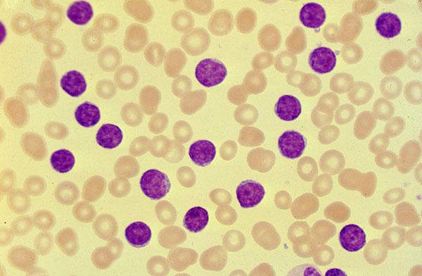 Sangue periférico normal Sangue periférico - leucemia aguda