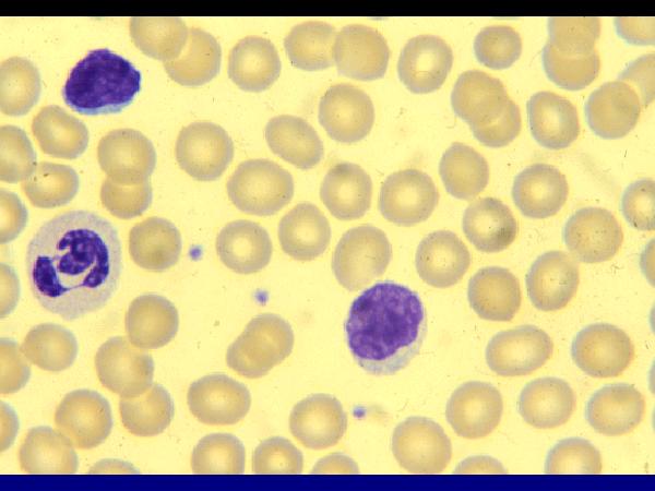 anemia Linfadenopatia Hepatoesplenomegalia Ossos e articulações Pele