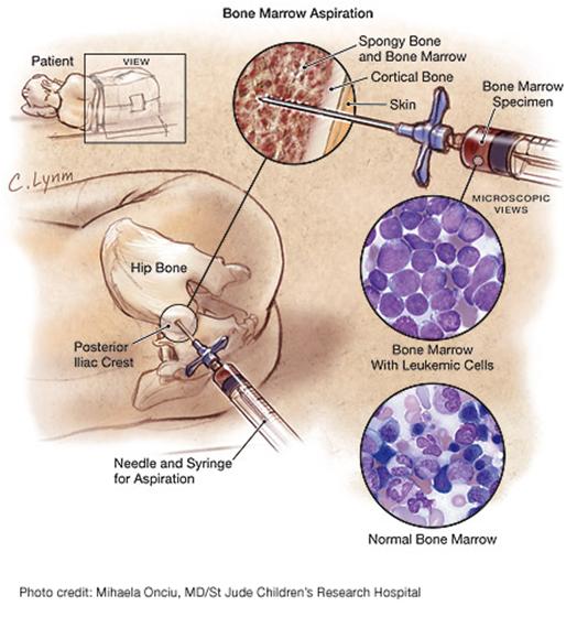 Leucemias agudas diagnóstico Mielograma/ biópsia MO > 25% blastos LLA >20% blastos LMA Imunofenotipagem com Ac monoclonais CD2, CD7, CD10, TdT, CD19, CD13, CD33, cig, sig Outros exames: LCR USG