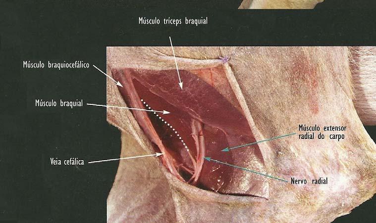 Ligeiramente cranial à porção acromial do músculo deltóide sobre o tubérculo maior, é realizada uma incisão de aproximadamente 3 a 5 cm.