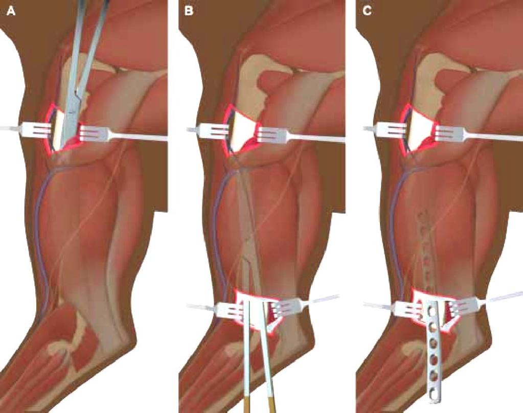 37 Figure 20 - Esquema da abordagem cirúrgica do úmero. A, porção proximal da inserção da placa após incisão dos músculos deltóide e braquial.