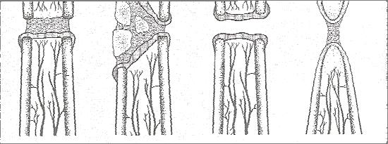 44 abertura dos canais medulares para permitir a vascularização (FOSSUM, 2008). Os tecidos fibrosados das extremidades devem ser removidos promovendo um sangramento (PIERMATTEI et al., 2009).