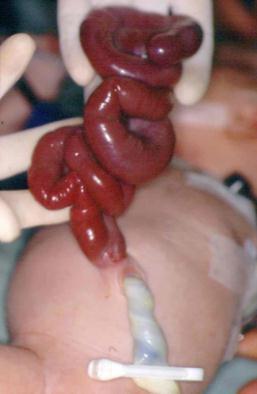 gastrostomia 8. Geralmente há associação com má-rotação intestinal. Pode ocorrer isquemia de alças intestinais (Fig.